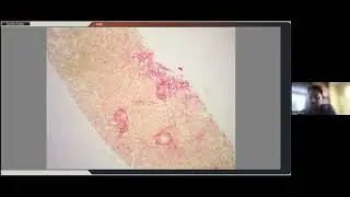 Vanishing Bile Duct Sydrome - Prof Martin Hale & Dr Bilal Bobat