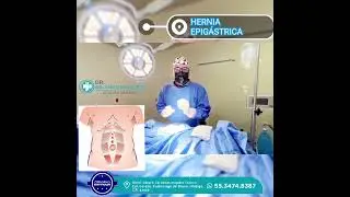 Diferencia entre una Hernia Epig&aacute;strica y una Hernia Umbilical. #hernia