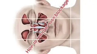 How do doctors remove nose blockage