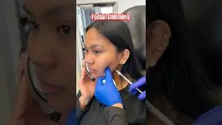 Facial Slimming Injections | Neurotoxin | Masseter Muscle | @doctoryovino #plasticsurgery