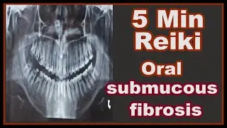 Reiki l Oral Submucous Fibrosis l 5 Minute Session l Healing Hands Series