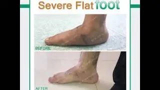 Severe flat foot