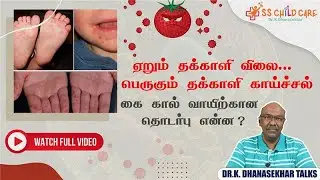 Tomato Fever| குழந்தைகளை தாக்கும் தக்காளி காய்ச்சல் | HFMD | Hand Foot Mouth Disease