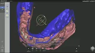37 Scanning metal trays and bite tray impression