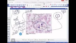 UWorld Heme-Onc 🧠 | No spleen? Say hello to Howell&ndash;Jolly bodies.