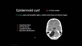 Imaging intracerebral cysts DRE Prof  Mamdouh Mahfouz HD