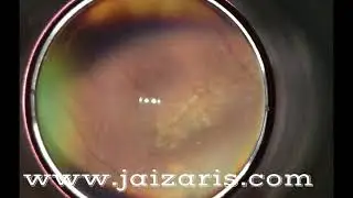 Peripheral Retina Imaging using Jaiz RetiCAM