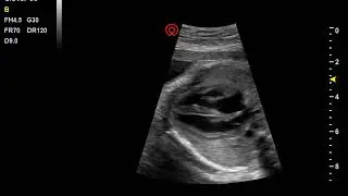 Clover 60  Fetal heart Wisonic