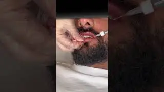 Lip Filler for men 😍 ❌❌❌