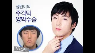 Long face syndrome and Two Jaw(Double Jaw) surgery