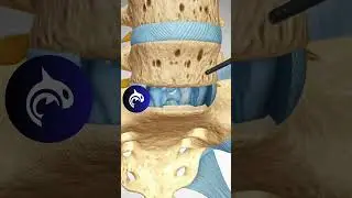 Anterior Lumbar Interbody Fusion ALIF - 4K 3D Animation
