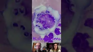 Fungi (Histoplasma) in the Peripheral Blood
