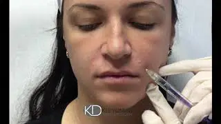 Juv&eacute;derm Vollure for Nasolabial Folds