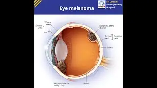 Eye melanoma ? || Know Symptoms and Causes of Eye melanoma! || #SLMSH