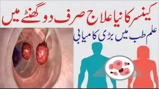 New Cancer Treatment in Just Two Hours Urdu Health News Universal Datcom.