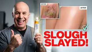 Ep 66: SANTYL, the slough slayer