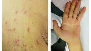 klinische Zeichen einer Lebererkrankung - Ikterus, Spidern&auml;vi, Palmarerythem, Aszites, Hepatomegalie