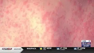 DHS confirms case of measles in Waukesha County