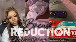 MY BREAST REDUCTION : 1 YEAR UPDATE | LIFE WITH A SPARKLE