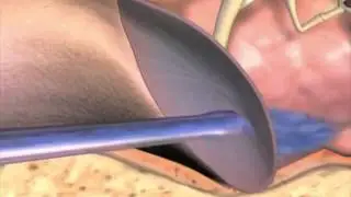 Drenaggio transtimpanico