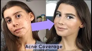 CURRENT ACNE COVERAGE FOUNDATION ROUTINE 2018♡ || How to Cover Acne using minimal product!