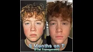 5 MONTHS ON TESTOSTERONE (FTM)