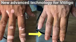 Vitiligo Skin color tattoo | Permanent solution for vitiligo white patch | Machu Tattoos
