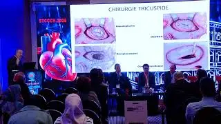 STCCCV-2025-Surgical outcomes in multivalvular patients : the tunisian experience-R  Denguir