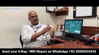 Bankart & Hill-sach Lesion, Labrum Tear, Recurrent Shoulder Dislocation: Causes & Treatment in India