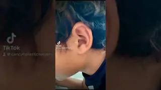 Ear reconstruction 👂🏼 #plasticsurgery #birthdefect