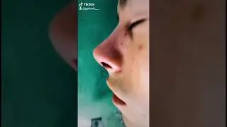 C&oacute;mo cambia la NARIZ despues de una RINOPLASTIA  | Antes y despues