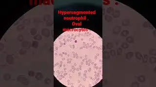 Hypersegmented neutrophil # oval macrocytes #bloodsmear