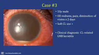 Diagnostic Approach in Suspected Microbial Keratitis: Pearls And Pitfalls
