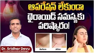 Avoid Thyroid Surgery || Safe, Scarless Treatment Explained in Telugu || Thyroid Problems || Dr Devu