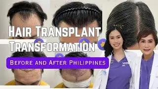 Hair Transplant Transformation Before and After Philippines | ABHRS Certified Surgeon | FUE & STRIP