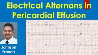 Electrical Alternans in Pericardial Effusion