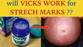 Do Vicks work for stretch Marks  | Tips to be followed | How to