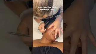 HydraFacial + extractions = glowing skin! 💧 Watch the process & results! #HydraFacial #Skincare
