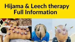 Hijama & Leech therapy full information for Hakeem kazi ( HIJAMA CUPPING THERAPY IN HINDI )#kzhijama