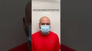 Before and after scalp micropigmentation #scalpmicropigmentation #smptraining #edmonton #smp