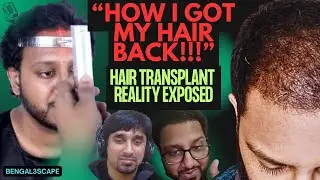 Hair Transplant in Bangladesh: Real Results & Cost | Fitness Guy Shares Being Bullied For Obesity!