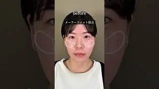 【小顔整形】ミチちゃんになりたい！#shorts