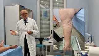 💥 Rottura di varici a cura del Dott. Francesco Pollice, chirurgo vascolare