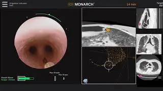 Auris Health Monarch Platform