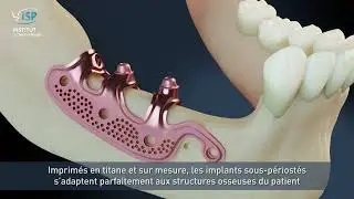 Traitement d'un &eacute;dentement post&eacute;rieur mandibulaire sans greffe osseuse avec un implant sous-p&eacute;riost&eacute;
