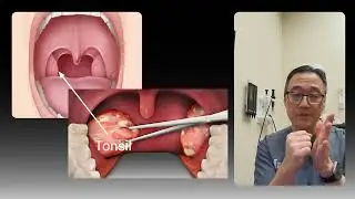 Tonsillectomy for tonsil stones?  Hear this first! #tonsilstones #shorts
