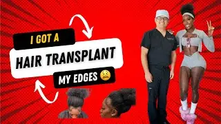 I GOT A HAIR TRANSPLANT FOR THESE EDGES - PART 1 (BLACK GIRL EDITION)