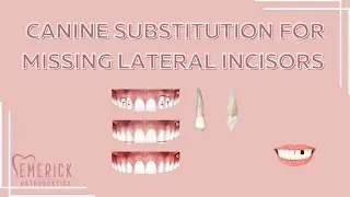 Canine Substitution for Missing Laterals