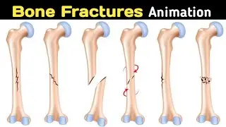 Bone fracture 3d animation/types of bone fracture in hindi/Dr Bilal Hassan
