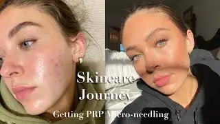 Skincare Journey part 1: Getting PRP Micro-Needling 💉🩸